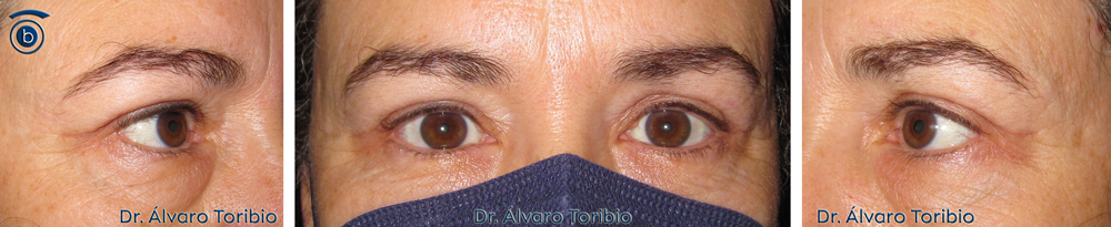 Blefaroplastia Superior - Dr. Toribio en León- blefaroplastia láser superior