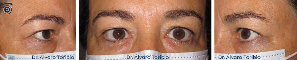 Blefaroplastia Superior - Dr. Toribio en León- Mujer con exceso de piel en párpados superiores